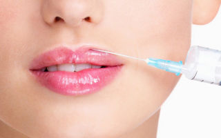 How long will the swelling from the lips after hyaluronic acid subside?